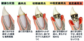 歯の状態